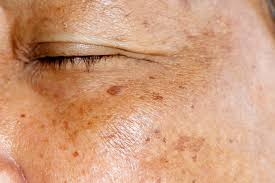 Treatment Options for Hyperpigmentation