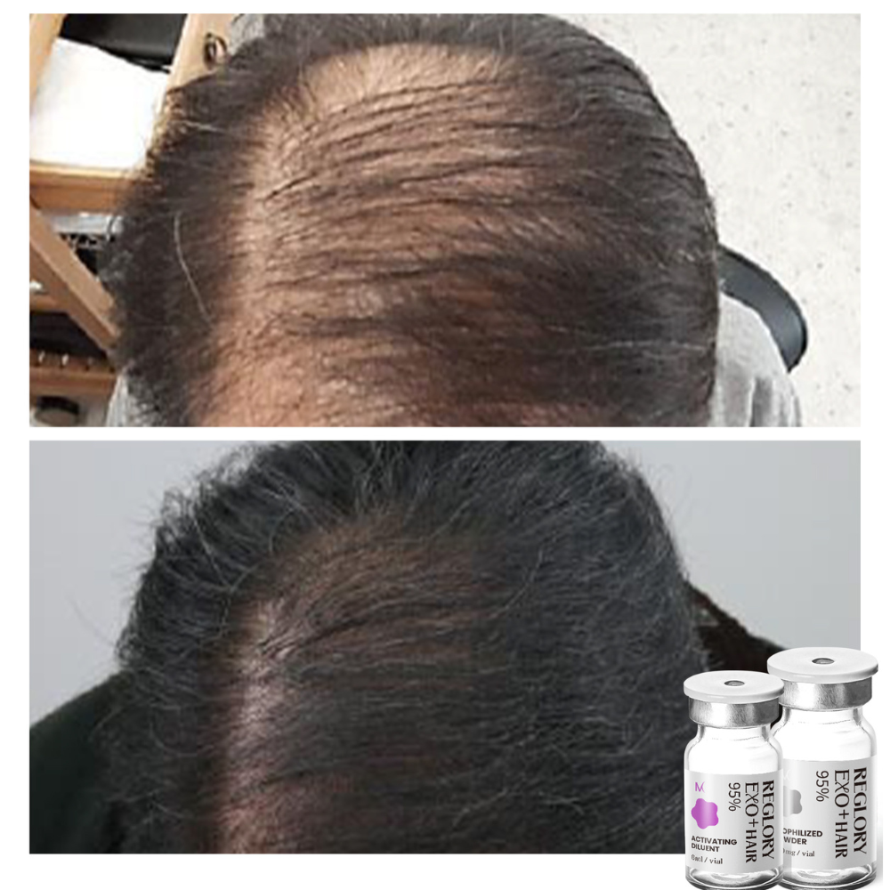 Before and after picture showing results after consistently treatment with Reglory EXO⁺ Hair Growth Serum. Showing more hair growth.