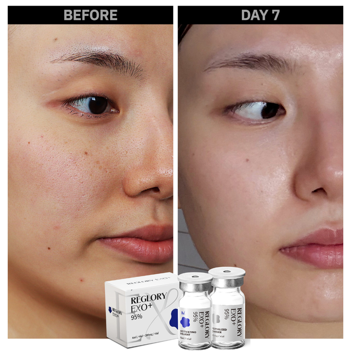 Showing before and after Day 7 Reglory_EXO_Exosome_Skin_Booster skin looks heathier