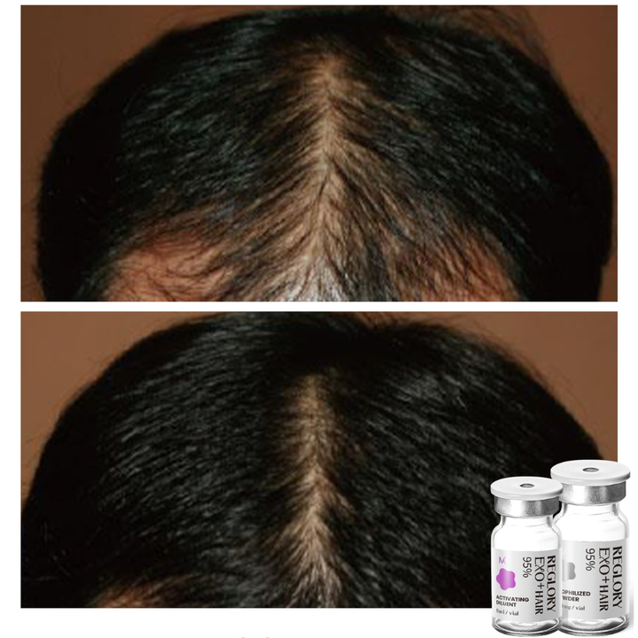 Before and after picture showing results after consistently treatment with Reglory EXO⁺ Hair Growth Serum. Showing more hair growth.