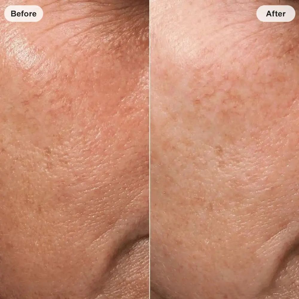 Before and after skin comparison showing smoother-looking texture after using the 5-in-1 Smart RF & EMS Facial Lifting Device.