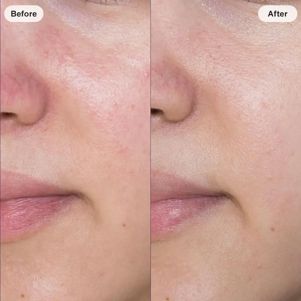 Before and after facial skin comparison showing a smoother and more refined-looking complexion.