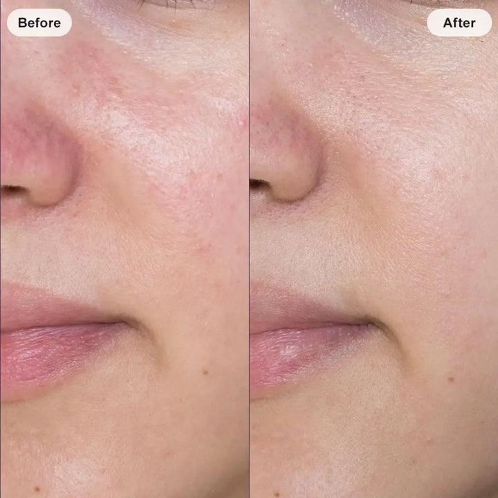 Before and after facial skin comparison showing a smoother and more refined-looking complexion.