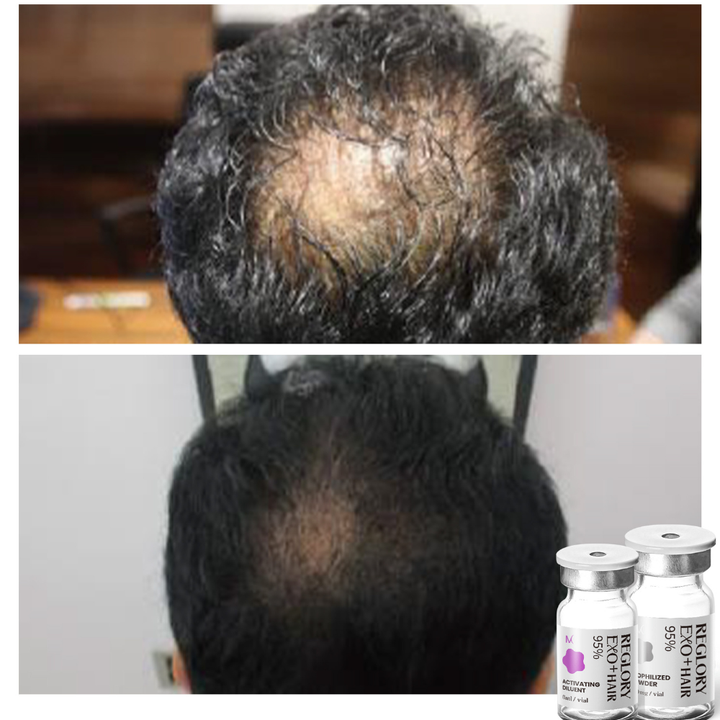 Before and after picture showing results after consistently treatment with Reglory EXO⁺ Hair Growth Serum. Showing more hair growth.
