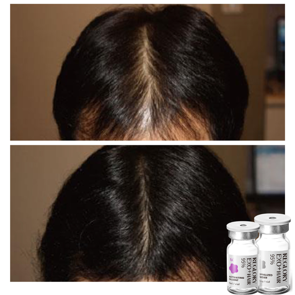 Before and after treatment with Reglory EXO⁺ Hair Growth Serum more hair growth