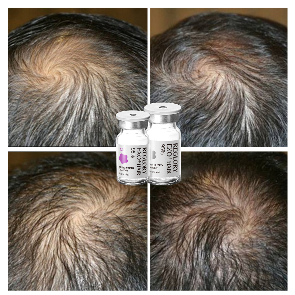 Showing progress of Reglory EXO⁺ Hair Growth Serum